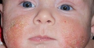 PHOTO: EAST NEWS/SCIENCE PHOTO LIBRARY MODEL RELEASED. Infected eczema on the face of a three month old baby boy. Eczema is a form of dermatitis, a skin irritation that causes itchiness and flaking of the skin. Scratching the skin can break the surface and cause infections. Treatment of infections is with antibiotics. Eczema itself is difficult to treat as its causes are largely unknown, and treatments are aimed at the symptoms. These include using moisturisers to prevent the skin drying out, and antihistamine creams or drugs to relieve itching.