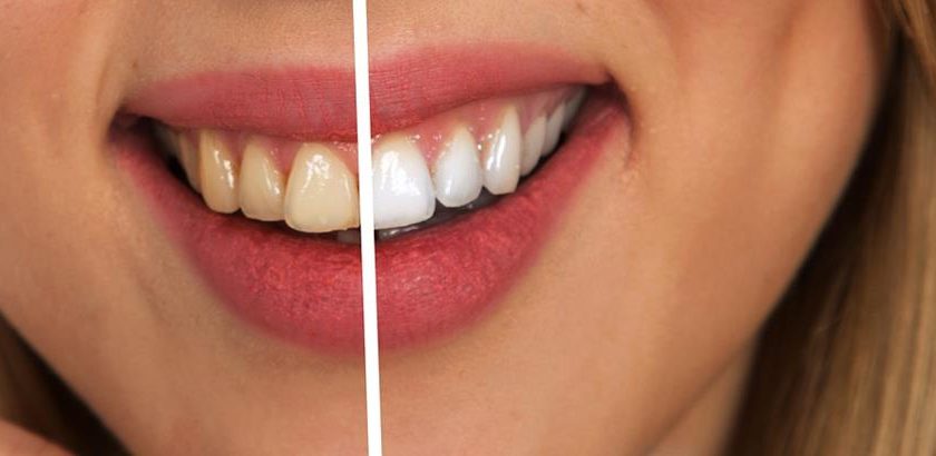 Jak dbać o higienę jamy ustnej podczas noszenia aparatu?