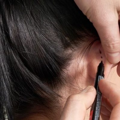 Korekta uszu – co trzeba wiedzieć o zabiegu i jak się do niego przygotować?