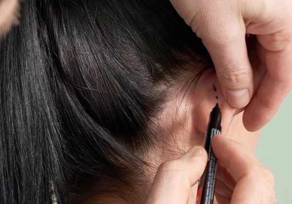 Korekta uszu – co trzeba wiedzieć o zabiegu i jak się do niego przygotować?